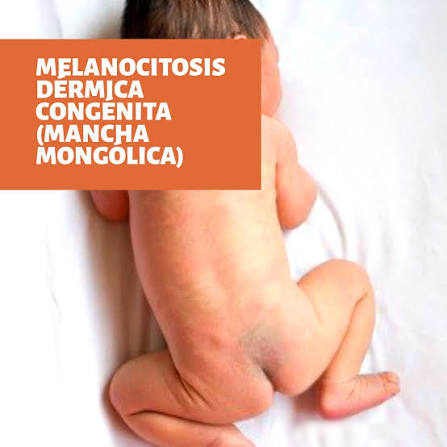 melancitosis